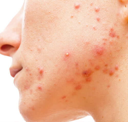 Acne and Skin Blemish Treatments